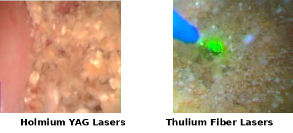 Thulium Fiber Laser (TFL)